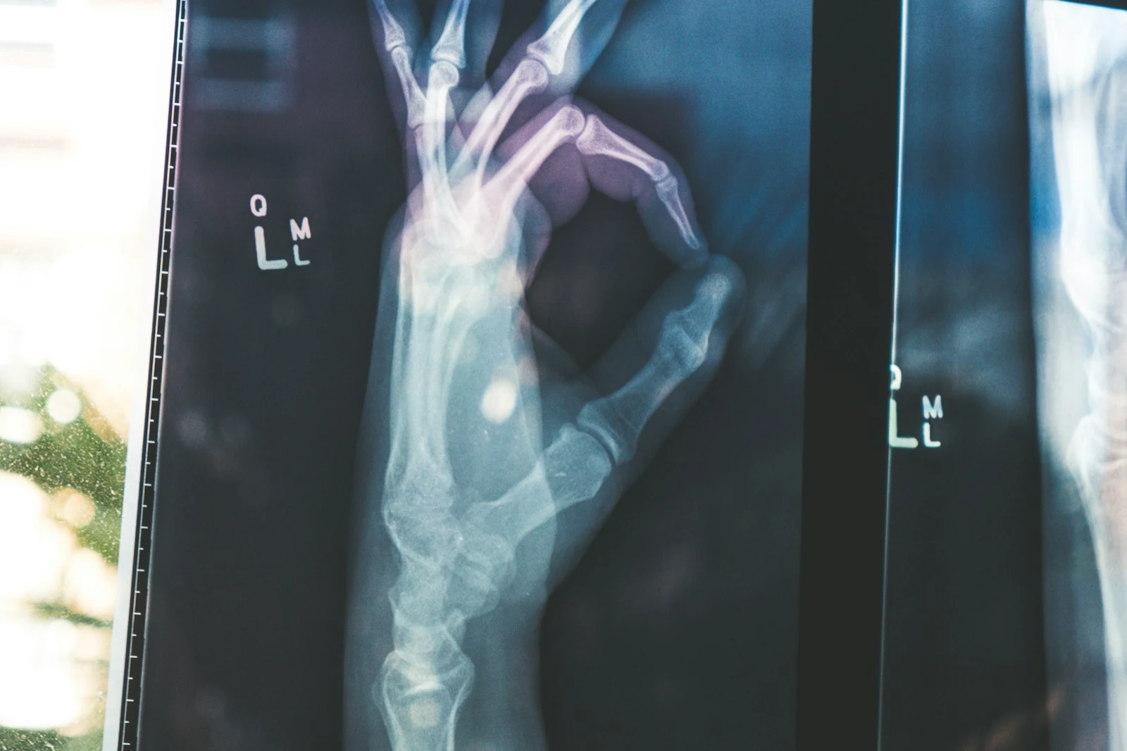 Medical imaging film showing the bones of a hand